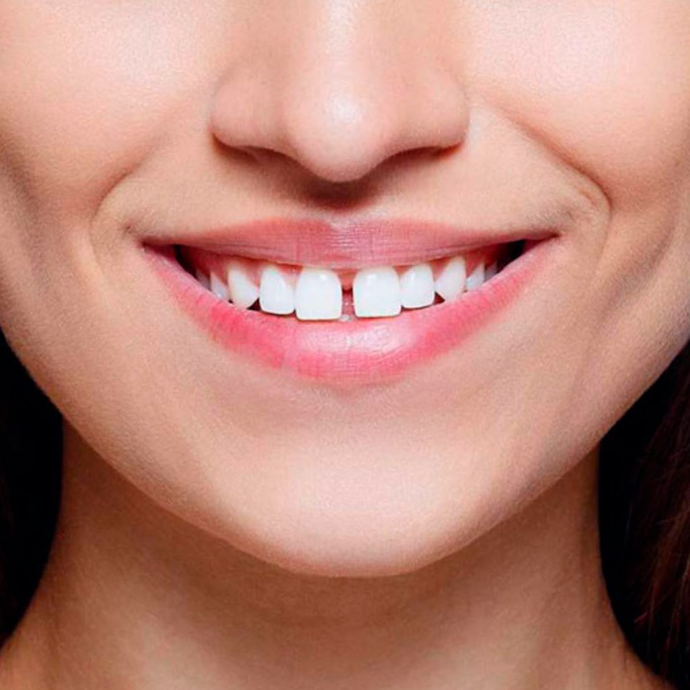 Diastema: quel piccolo spazio che fa la differenza nel sorriso!